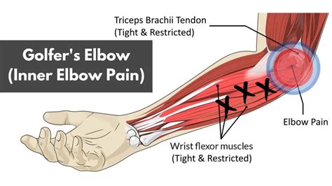 what is golfer's elbow.